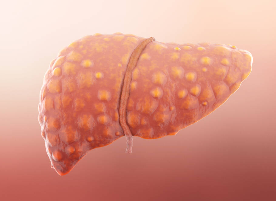 Novo medicamento pode finalmente acabar com a doença hepática gordurosa Cientistas identificaram um tratamento experimental que reduziu gordura no fígado